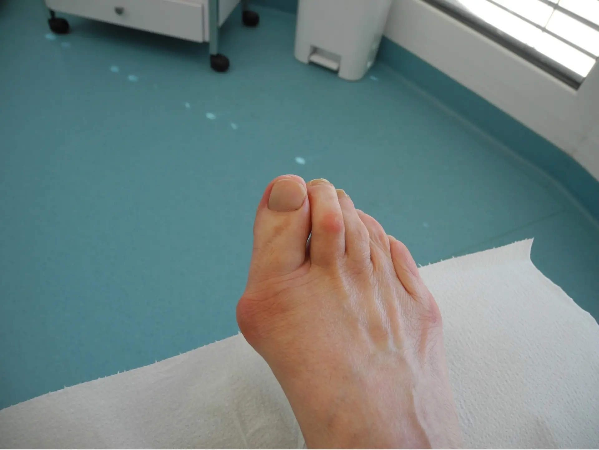 Ein Hallux Valgus am rechten Fuß