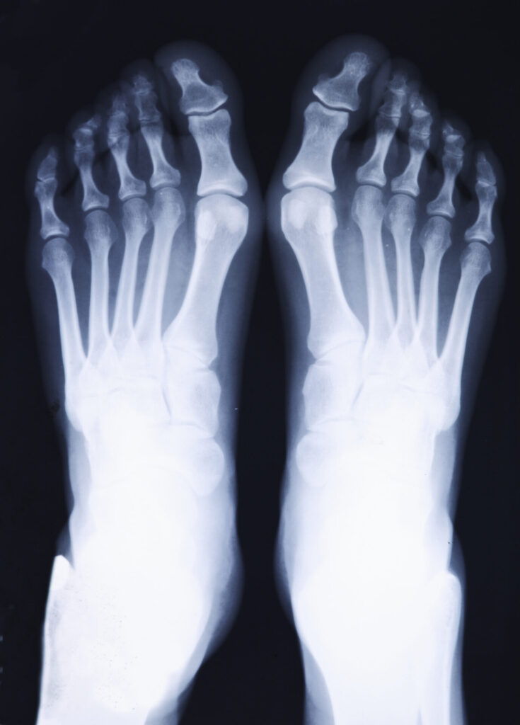 Nahaufnahme eines klassischen Röntgenbildes eines Hallux Valgus