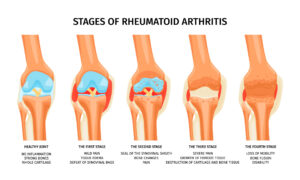 Realistische Infografik, die die vier Stadien der rheumatoiden Arthritis im Kniegelenk zeigt, Vektorillustration.