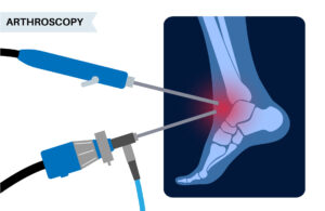 Minimally invasive ankle arthroscopy procedure.