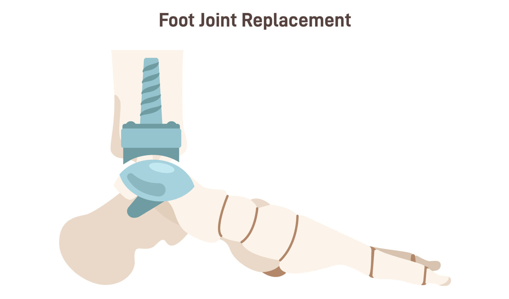 Joint implantation. Injured or distracted human ankle joint replaced with artificial prosthesis.