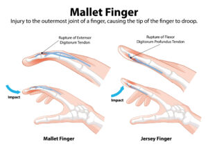 Types of extensor tendon finger