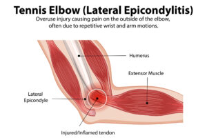 tennis arm details