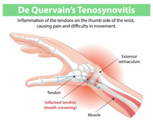 Tendovaginitis de Quervain