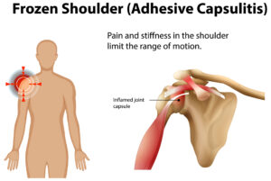 frozen shoulder